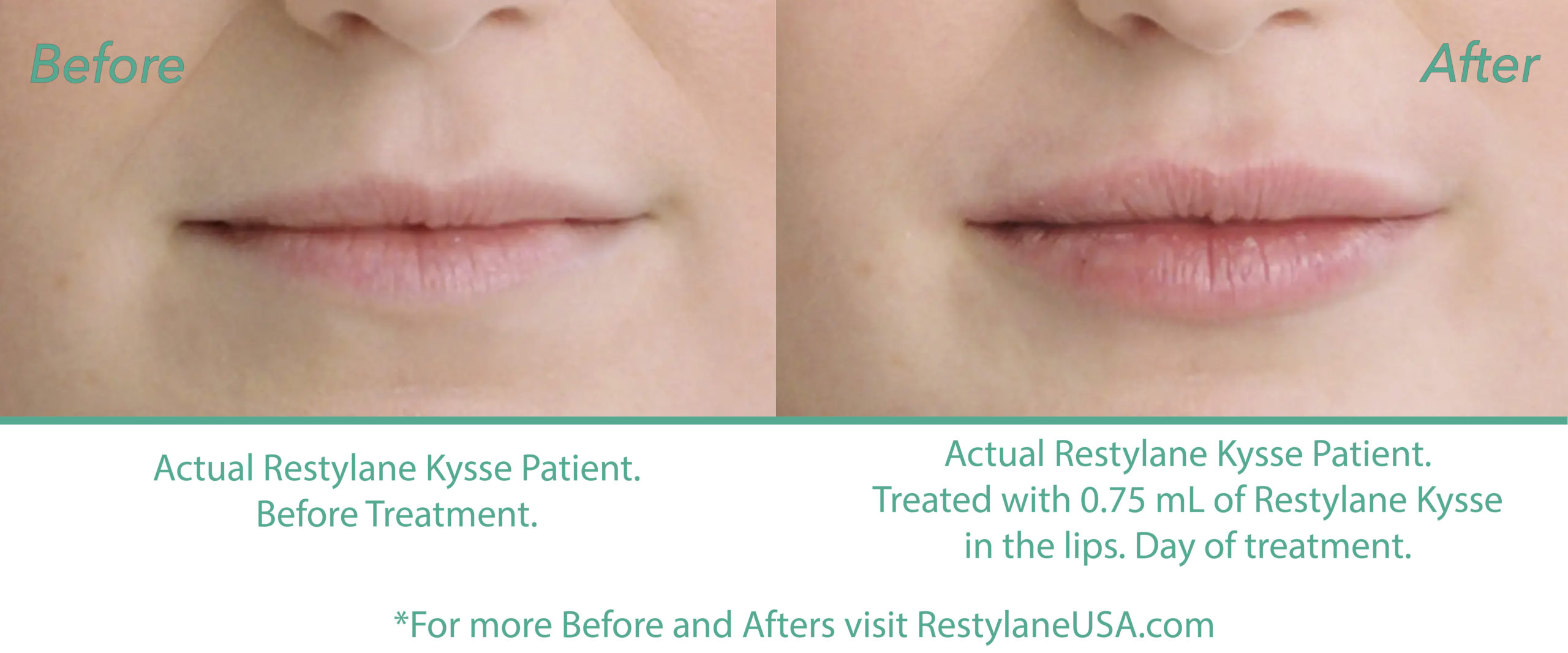 Restylane Kysse before and after