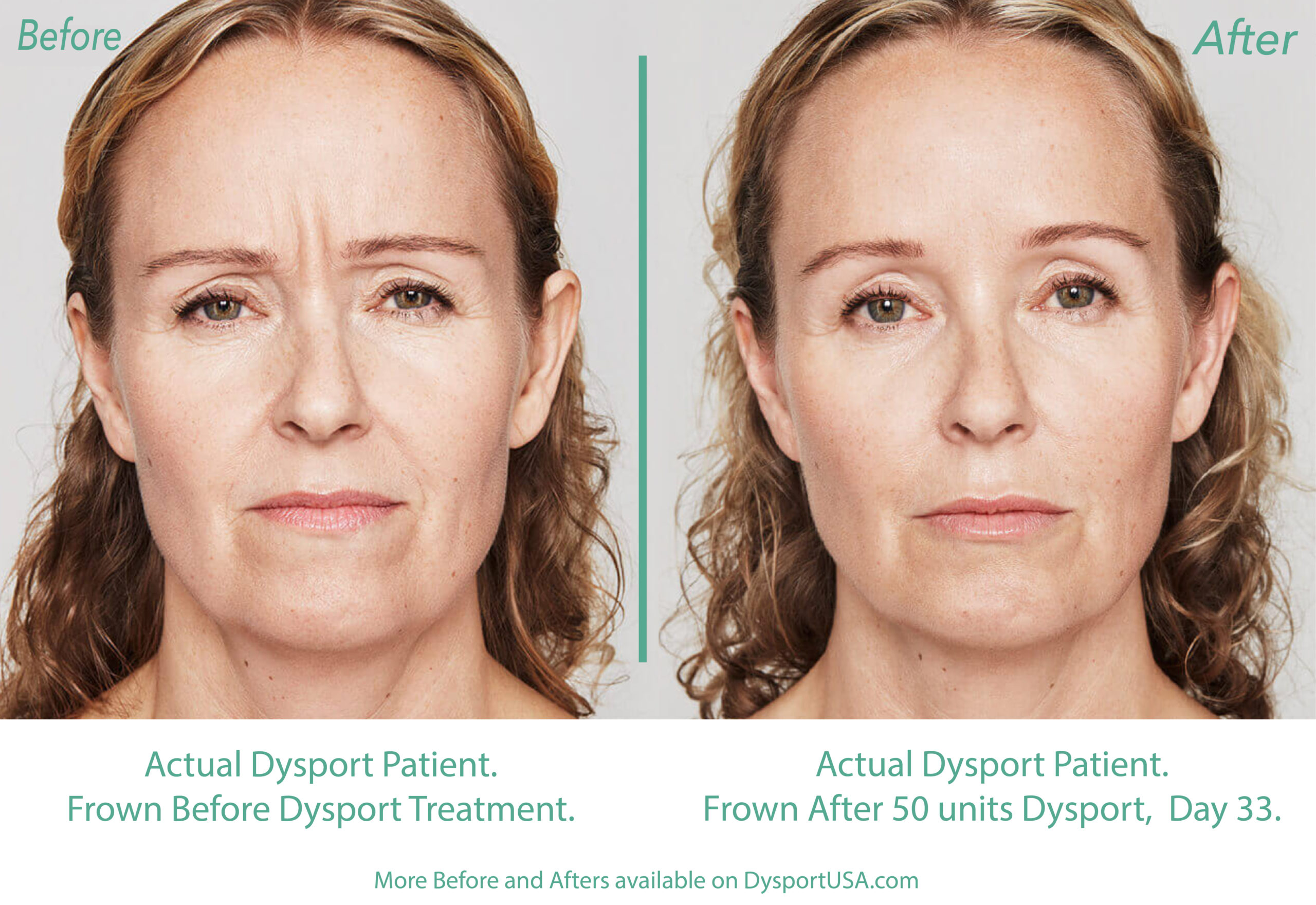Dysport or Botox before and After
